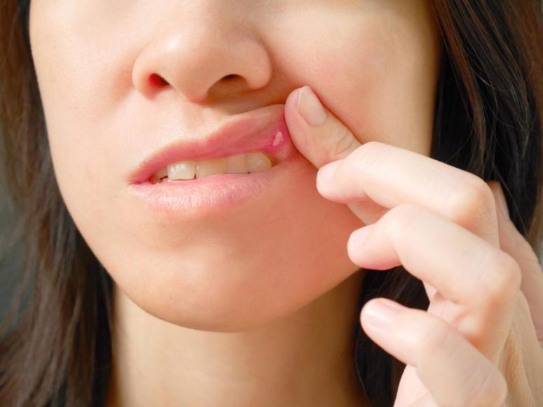 15 Effective Ways to Treat Canker Sores