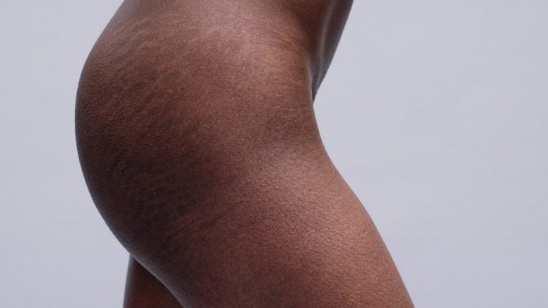 Stretch Marks: What causes them and how can you treat them?