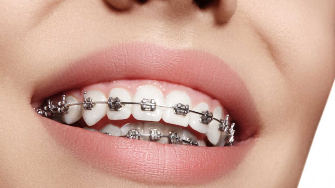 How Much Does Dental Braces Typically Cost in Singapore? 2024 Guide