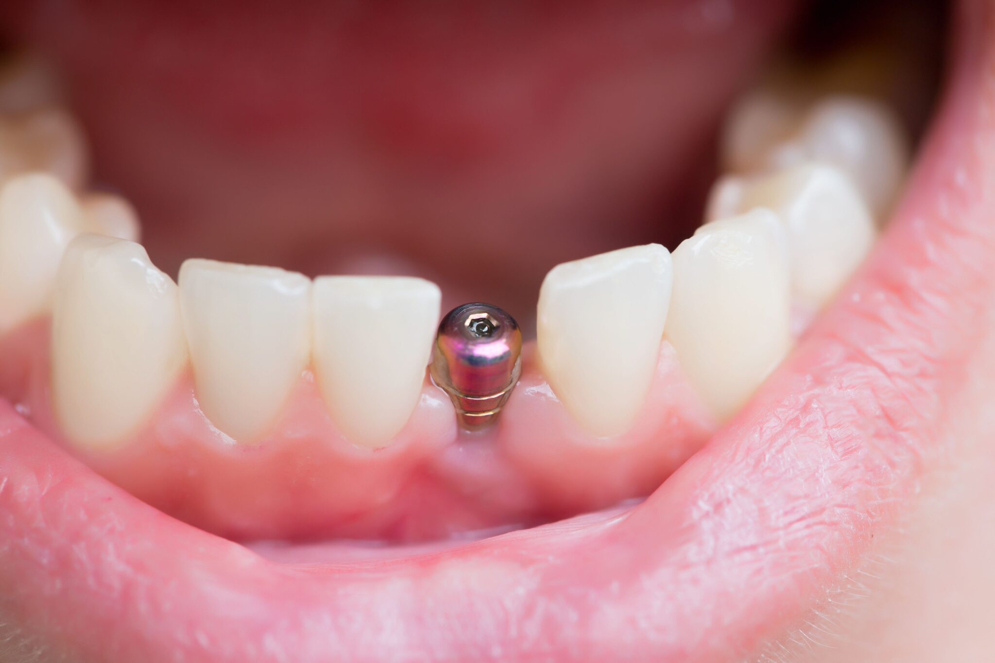 7 Tips For Fast Healing After Full Dental Implant Surgery Health Care Reform